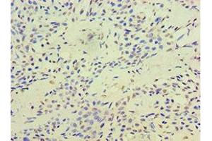 Immunohistochemistry of paraffin-embedded human breast cancer using ABIN7171737 at dilution of 1:100 (RAP1 抗体  (AA 1-280))