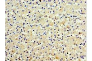 Immunohistochemistry of paraffin-embedded human liver cancer using ABIN7156612 at dilution of 1:100 (IL28B 抗体  (AA 22-196))