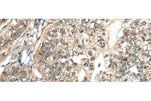 Immunohistochemistry of paraffin-embedded Human gastric cancer tissue using MCPH1 Polyclonal Antibody at dilution of 1:110(x200) (MCPH1 抗体)