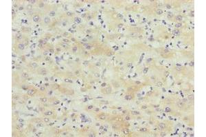 Immunohistochemistry of paraffin-embedded human liver cancer using ABIN7145848 at dilution of 1:100 (KCTD19 抗体  (AA 490-751))