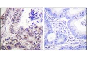 Immunohistochemistry analysis of paraffin-embedded human colon carcinoma, using Caspase 9 (Phospho-Ser144) Antibody. (Caspase 9 抗体  (pSer144))
