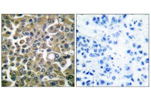 Immunohistochemical analysis of paraffin-embedded human breast carcinoma tissue using Keratin 16 antibody (ABIN5976436). (KRT16 抗体  (C-Term))