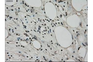 Immunohistochemical staining of paraffin-embedded Adenocarcinoma of ovary tissue using anti-BUB1Bmouse monoclonal antibody. (BUB1B 抗体)