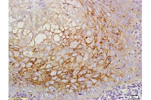 Formalin-fixed and paraffin embedded human laryngeal cancer labeled with Anti-CD44v5 Polyclonal Antibody, Unconjugated  at 1:200 followed by conjugation to the secondary antibody (CD44RC (AA 61-139) 抗体)