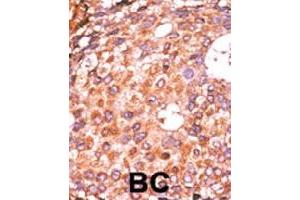 Formalin-fixed and paraffin-embedded human cancer tissue reacted with E2F1 (phospho S337) polyclonal antibody  which was peroxidase-conjugated to the secondary antibody followed by AEC staining. (E2F1 抗体  (pSer337))