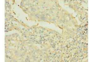 Immunohistochemistry of paraffin-embedded human lung cancer using ABIN7167504 at dilution of 1:100 (PTPRJ 抗体  (AA 140-370))