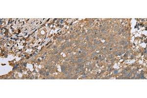 Immunohistochemistry of paraffin-embedded Human cervical cancer tissue using ALKBH8 Polyclonal Antibody at dilution of 1:25(x200) (ALKBH8 抗体)