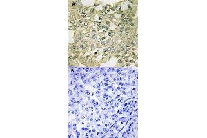 Immunohistochemical staining of human breast carcinoma tissue by PKMYT1 (phospho S83) polyclonal antibody  without blocking peptide (A) or preincubated with blocking peptide (B) under 1:50-1:100 dilution. (PKMYT1 抗体  (pSer83))