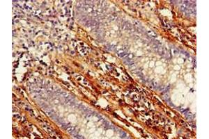 Immunohistochemistry of paraffin-embedded human colon cancer using ABIN7165903 at dilution of 1:100 (Patched 1 抗体  (AA 1180-1411))