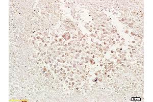 Formalin-fixed and paraffin embedded mouse tumor tissue labeled with Anti-TRAF1 Polyclonal Antibody, Unconjugated (ABIN673464) at 1:200 followed by conjugation to the secondary antibody and DAB staining. (TRAF1 抗体  (AA 301-416))