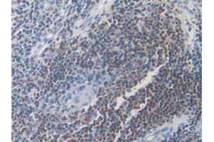 IHC-P analysis of Human Skin Cancer Tissue, with DAB staining. (DOK3 抗体  (AA 128-385))