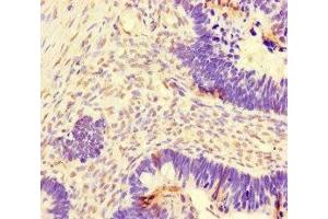 Immunohistochemistry of paraffin-embedded human ovarian cancer using ABIN7150550 at dilution of 1:100 (DNAJC3 抗体  (AA 277-496))