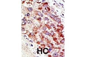 Formalin-fixed and paraffin-embedded human cancer tissue reacted with the primary antibody, which was peroxidase-conjugated to the secondary antibody, followed by AEC staining. (CBLC 抗体  (N-Term))
