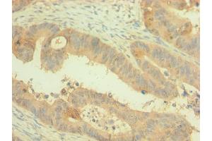 Immunohistochemistry of paraffin-embedded human colon cancer using ABIN7162499 at dilution of 1:100 (PAX4 抗体  (AA 50-200))