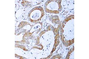 Immunohistochemical analysis of TRADD staining in human colon cancer formalin fixed paraffin embedded tissue section. (TRADD 抗体  (C-Term))