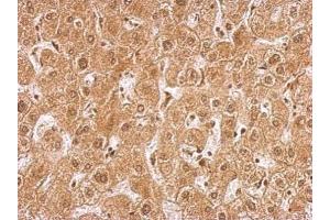 IHC-P Image AMPK gamma 2 antibody [C2C3], C-term detects PRKAG2 protein at nucleus and cytosol human on hepatoma by immunohistochemical analysis.