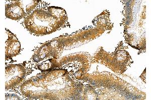 ABIN6264411 and ABIN6276954 at 1/100 staining Human colorectal cancer by IHC-P. (Peroxiredoxin 2 抗体  (C-Term))