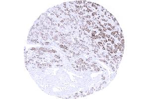 Kidney Clear cell renal cell carcinoma showing moderate to strong Melan A immunostaining of tumor cells (Recombinant MLANA 抗体)