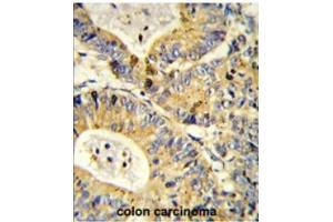 Formalin-fixed and paraffin-embedded human colon carcinoma reacted with RS18 Antibody (Center) followed which was peroxidase-conjugated to the secondary antibody, followed by DAB staining. (RPS18 抗体  (Middle Region))