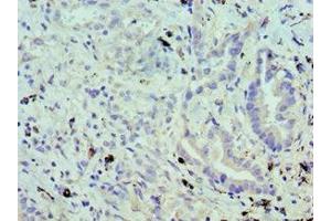 Immunohistochemistry of paraffin-embedded human lung cancer using ABIN7174459 at dilution of 1:100 (UBE2J2 抗体  (AA 1-230))