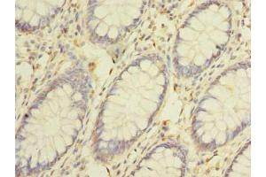 Immunohistochemistry of paraffin-embedded human colon cancer using ABIN7147425 at dilution of 1:100 (Cep76 抗体  (AA 241-550))