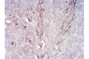 Immunohistochemical analysis of paraffin-embedded bladder cancer tissues using RAB11FIP1 mouse mAb with DAB staining. (RAB11FIP1 抗体  (AA 130-271))