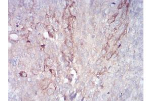 Immunohistochemical analysis of paraffin-embedded bladder cancer tissues using RAB11FIP1 mouse mAb with DAB staining.