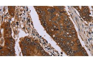 Immunohistochemistry of paraffin-embedded Human colon cancer using Catenin gamma Polyclonal Antibody at dilution of 1:40 (JUP 抗体)
