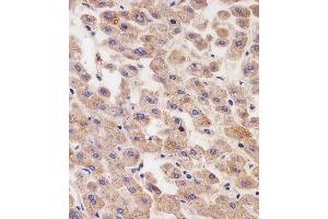 (ABIN6242760 and ABIN6577246) staining AFP in human liver tissue sections by Immunohistochemistry (IHC-P - paraformaldehyde-fixed, paraffin-embedded sections). (alpha Fetoprotein 抗体  (AA 281-609))