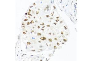 Immunohistochemistry of paraffin-embedded human lung cancer using THOC1 antibody (ABIN5974800) at dilution of 1/100 (40x lens). (THOC1 抗体)