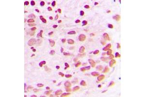 Immunohistochemical analysis of PML staining in human breast cancer formalin fixed paraffin embedded tissue section. (PML 抗体  (N-Term))