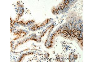 Immunohistochemistry of Human gastric cancer using TRPC6 Polyclonal Antibody at dilution of 1:40 (TRPC6 抗体)