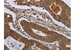 The image on the left is immunohistochemistry of paraffin-embedded Human colon cancer tissue using ABIN7191233(KLRF1 Antibody) at dilution 1/30, on the right is treated with synthetic peptide. (KLRF1 抗体)