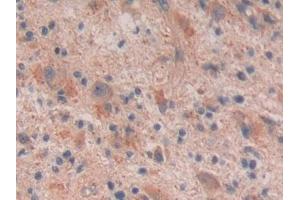 DAB staining on IHC-P; Samples: Human Glioma Tissue (Reelin 抗体  (AA 26-190))