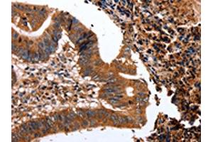 The image on the left is immunohistochemistry of paraffin-embedded Human colon cancer tissue using ABIN7128966(CLEC4A Antibody) at dilution 1/15, on the right is treated with fusion protein. (CLEC4A 抗体)