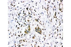 IHC-P: Glucocorticoid receptor antibody testing of human breast cancer tissue