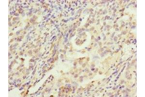 Immunohistochemistry of paraffin-embedded human lung cancer using ABIN7142261 at dilution of 1:100 (MRPS22 抗体  (AA 1-360))