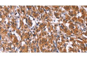 Immunohistochemistry of paraffin-embedded Human thyroid cancer tissue using TDP2 Polyclonal Antibody at dilution 1:40 (TDP2 抗体)