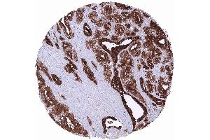 Prostate Adenocarcinoma Gleason 336 showing strong PSA positivity of tumor cells (Recombinant Prostate Specific Antigen 抗体  (AA 150-250))