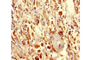 Immunohistochemistry of paraffin-embedded human melanoma using ABIN7165358 at dilution of 1:100 (FAM114A2 抗体  (AA 1-505))