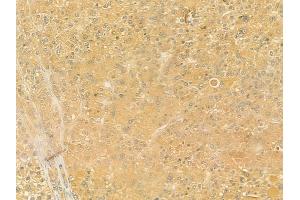 ABIN6257909 and ABIN6274573 at 1/100 staining human hepatocellular carcinoma by IHC-P. (HTR2C 抗体  (Internal Region))
