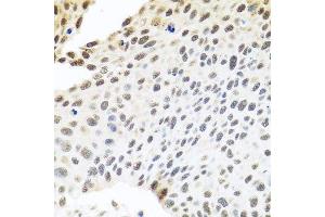 Immunohistochemistry of paraffin-embedded human lung cancer using SKIV2L2 antibody. (MTR4 抗体  (AA 1-304))