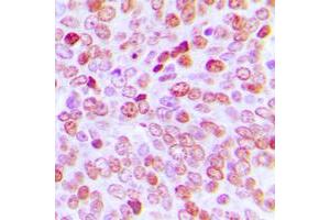 Immunohistochemical analysis of TBP staining in human prostate cancer formalin fixed paraffin embedded tissue section. (TBP 抗体  (Center))