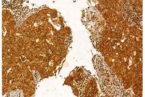 ABIN6264299 and ABIN6272885 at 1/100 staining Human lung cancer by IHC-P.
