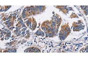 Immunohistochemistry of paraffin-embedded Human colon cancer tissue using NPPA Polyclonal Antibody at dilution 1:60 (NPPA 抗体)