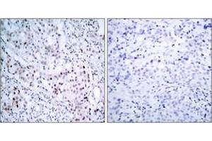 Immunohistochemistry analysis of paraffin-embedded human breast carcinoma, using c-Jun (Phospho-Ser63) Antibody. (C-JUN 抗体  (AA 31-80))
