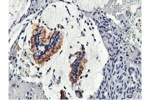 Immunohistochemical staining of paraffin-embedded Adenocarcinoma of Human colon tissue using anti-CAPN9 mouse monoclonal antibody. (Calpain 9 抗体)