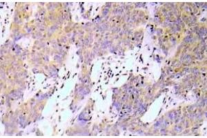 Immunohistochemistry (IHC) analyzes of NFkB-p65 pAb in paraffin-embedded human lung adenocarcinoma tissue. (NF-kB p65 抗体)