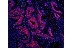 IF analysis of TDRD3 using anti-TDRD3 antibody (ABIN6719636) TDRD3 was detected in paraffin-embedded section of human intestinal cancer tissues. (TDRD3 抗体)
