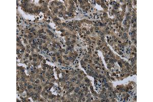 Immunohistochemistry of Human liver cancer using FTO Polyclonal Antibody at dilution of 1:60 (FTO 抗体)